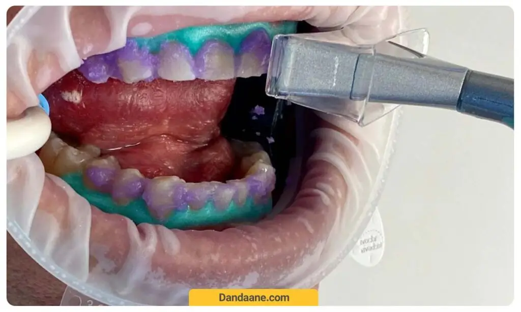 بهترین روش سفید کردن دندان ها بعد از ارتودنسی بلیچینگ است.