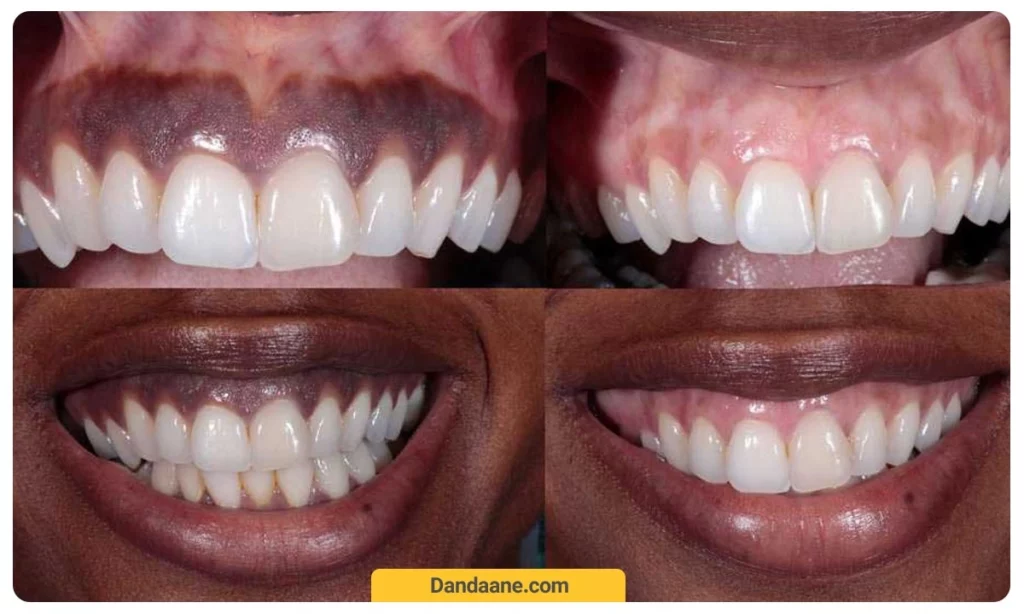 بیماری های مرتبط با سیاه شدن لثه