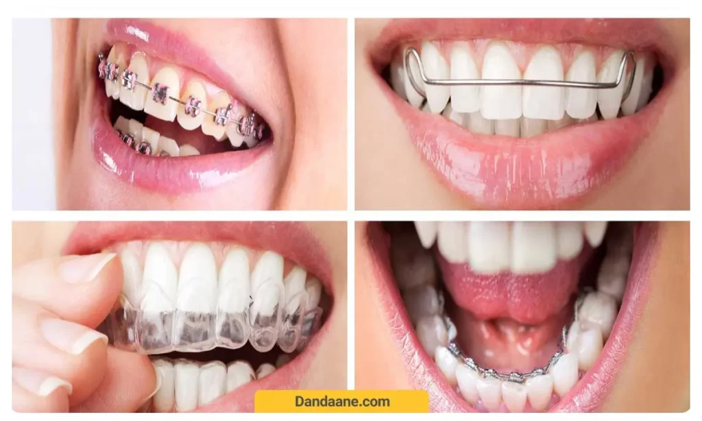انواع روش ارتودنسی دندان 