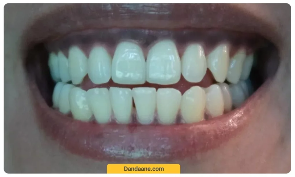 نشانه های سیاه شدن لثه