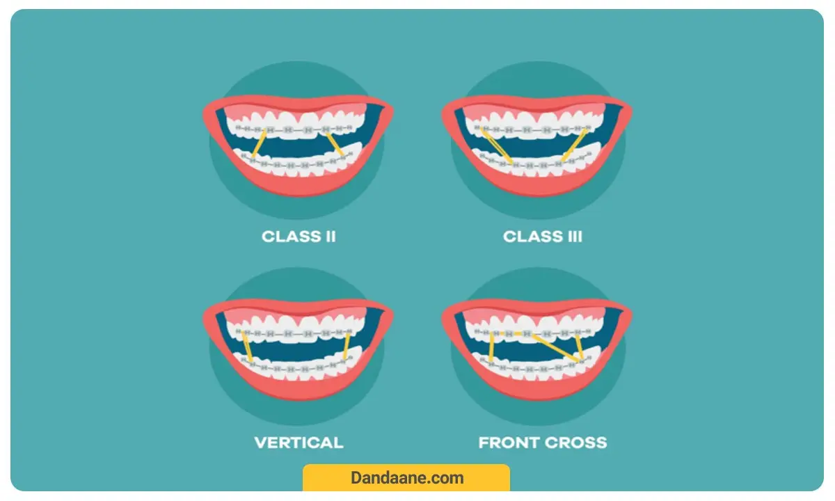 انواع کش ارتودنسی 