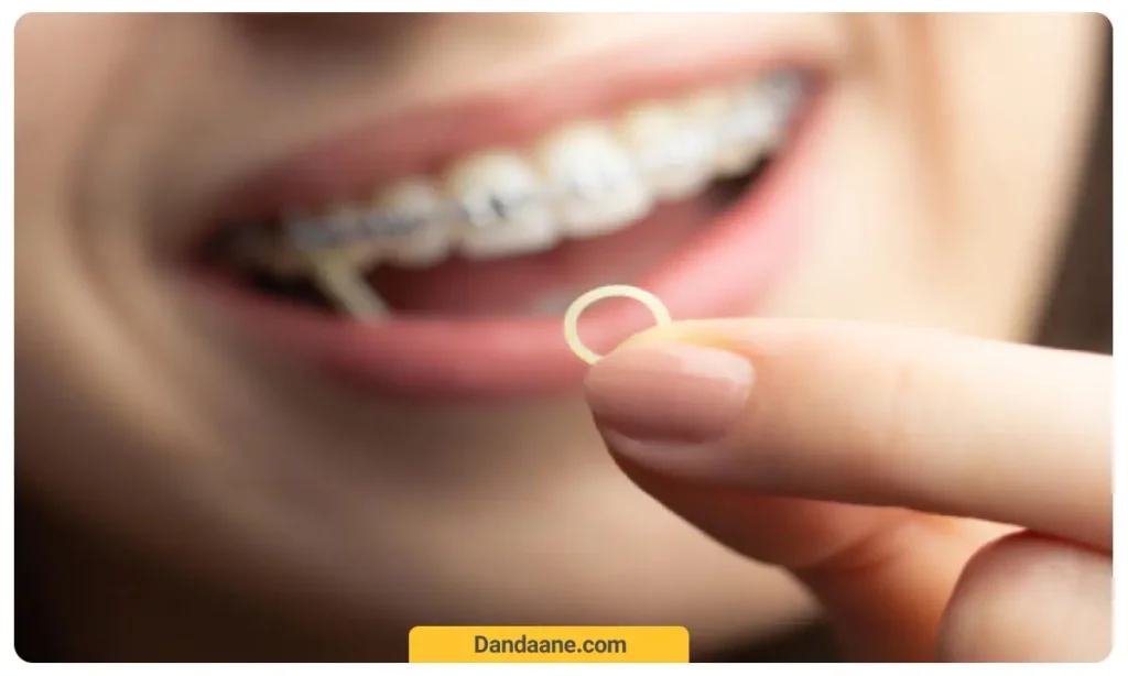 نگهداری کش ارتودنسی 