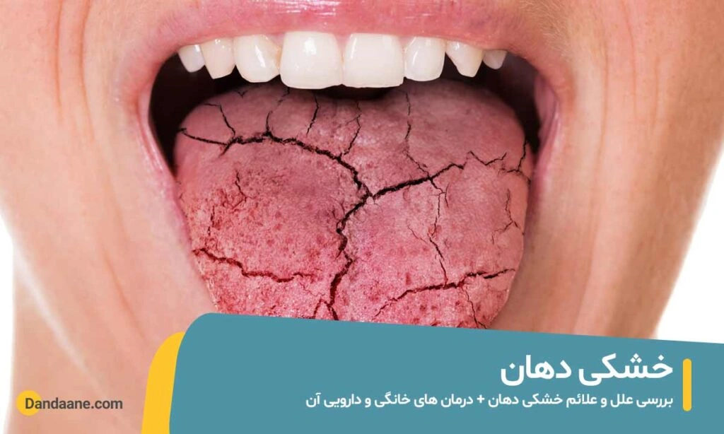 خشکی دهان