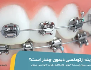 قیمت ارتودنسی دیمون چقدر است؟
