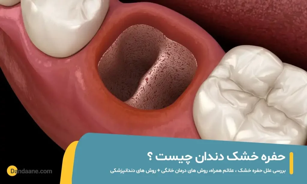حفره خشک دندان
