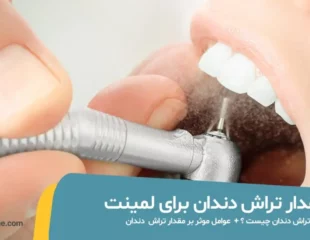 مقدار تراش دندان برای لمینت
