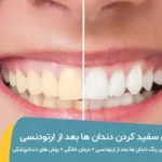 سفید کردن دندان ها