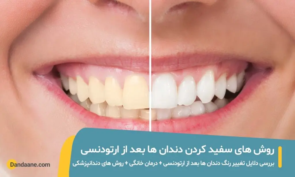 سفید کردن دندان ها
