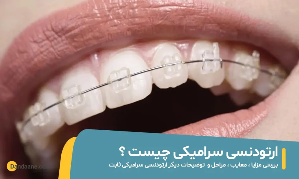 ارتودنسی سرامیکی چیست