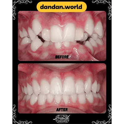 عکس قبل و بعد نمونه کار ارتودنسی دکتر مهدیه خسروی