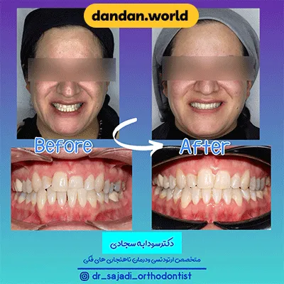 قبل و بعد نمونه کار ارتودسنی بزرگسالان دکتر سداوبه سجادی