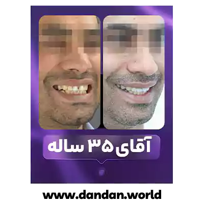 قبل و بعد نمونه کار ارتودنسی بزرگسالان دکتر مینو سادات علوی