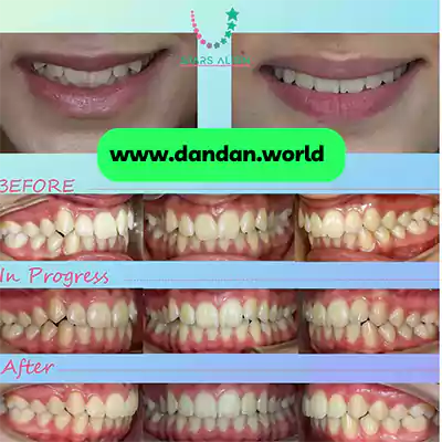 قبل و بعد نمونه کار ارتودنسی دندان دکتر حسین شصت فولادی