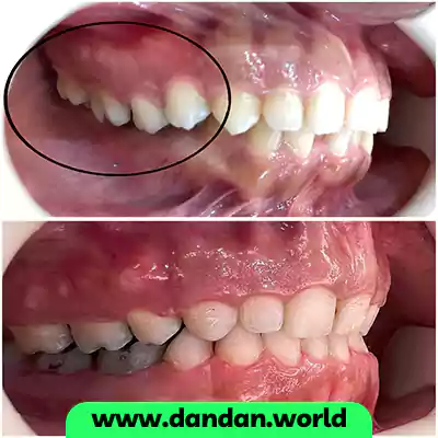 قبل و بعد نمونه کار ارتودنسی دکتر حنانه السادات حسینی