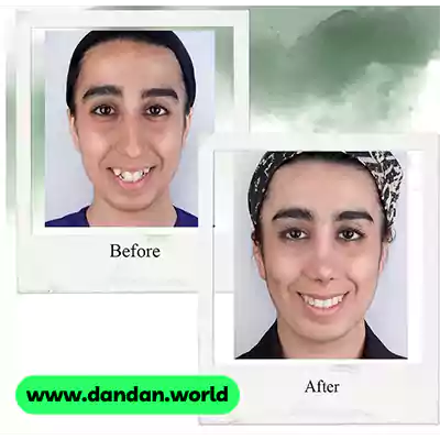 قبل و بعد نمونه کار ارتودنسی دکتر صفیه عباسی