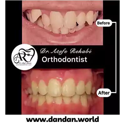 قبل و بعد نمونه کار ارتودنسی دکتر عاطفه رکابی