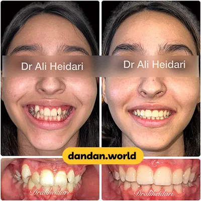 قبل و بعد نمونه کار ارتودنسی دکتر علی حیدری