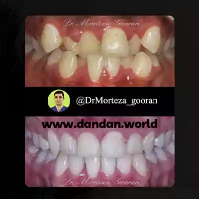 قبل و بعد نمونه کار ارتودنسی دکتر مرتضی گوران