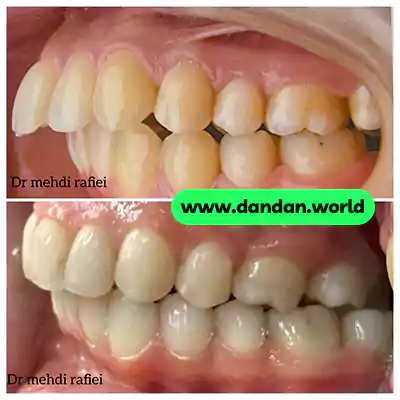 قبل و بعد نمونه کار ارتودنسی دکتر مهدی رفیعی