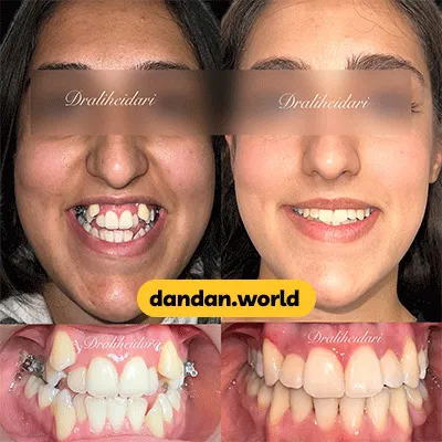 قبل و بعد نمونه کار ارتودنسی کودکان دکتر علی حیدری