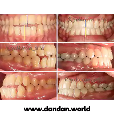 قبل و بعد نمونه کار درمان ارتودنسی دندان دکتر عبدالمحمد گچ کوبان