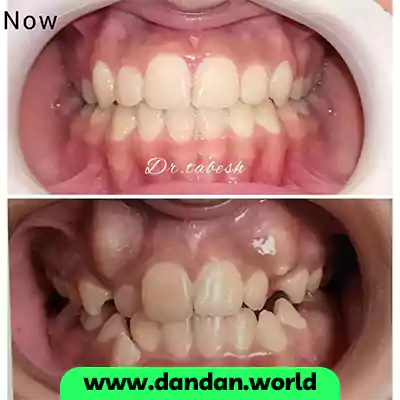قبل و بعد نمونه کار درمان ارتودنسی دکتر بهرنگ تابش