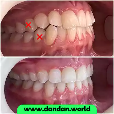 قبل و بعد نمونه کار درمان ارتودنسی دکتر حنانه السادات حسینی