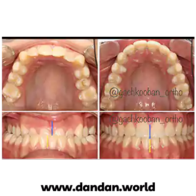 قبل و بعد نمونه کار درمان ارتودنسی دکتر عبدالمحمد گچ کوبان