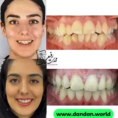 قبل و بعد نمونه کار درمان ارتودنسی دکتر مهدی رفیعی