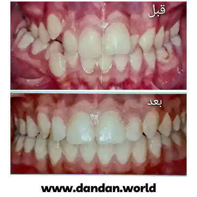 قبل و بعد نمونه کار درمان ارتودنسی دکتر مینو سادات علوی