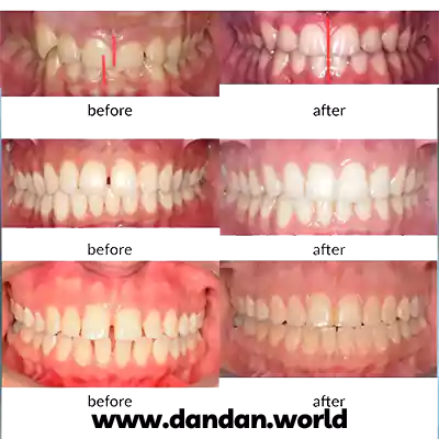 نمونه کارهای درمان ارتودنسی دکتر مینو سادات علوی