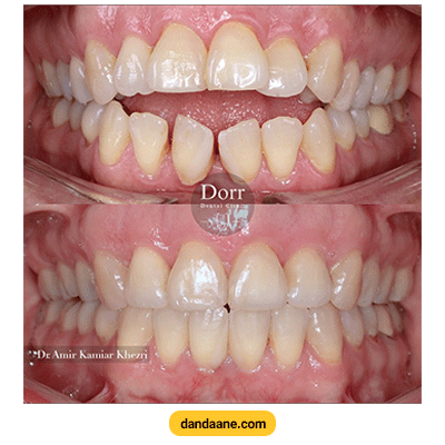 نمونه کار ارتودنسی دکتر امیر کامیار خضری شماره 1
