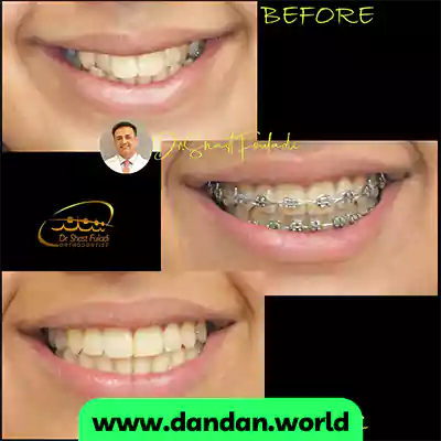 قبل و بعد نمونه کار ارتودنسی دندان دکتر حسین شصت فولادی
