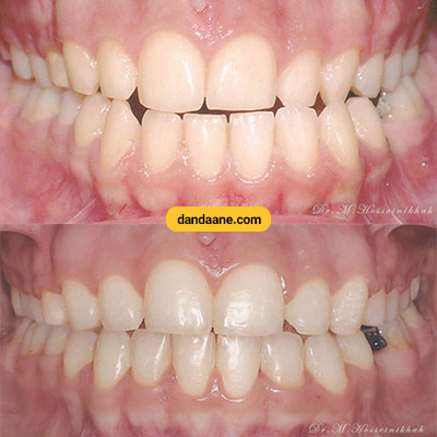 نمونه کار ارتودنسی دکتر محمد حسینی خواه شماره 1