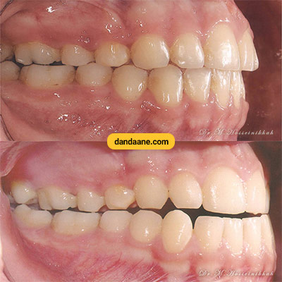 نمونه کار ارتودنسی دکتر محمد حسینی خواه