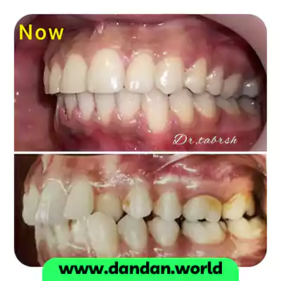 نمونه کار ارتودنسی نامرئی دکتر بهرنگ تابش