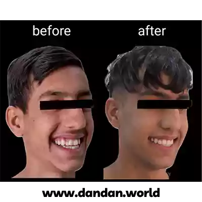 نمونه کار ارتودنسی کودکان دکتر مینو سادات علوی