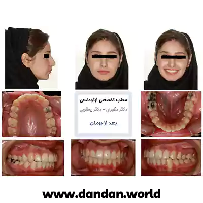 نمونه کار بعد درمان ارتودنسی دکتر مهدی یعقوبی اشرفی