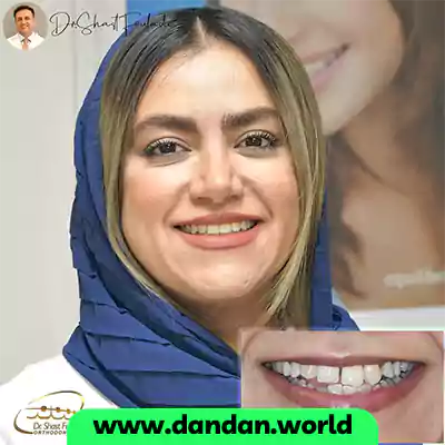 قبل و بعد نمونه کار ارتودنسی دندان دکتر حسین شصت فولادی