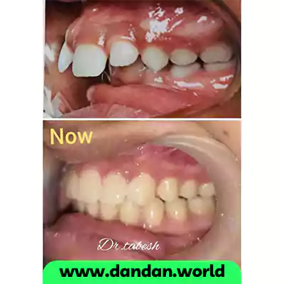 نمونه کار درمان ارتودنسی فانکشنال دکتر بهرنگ تابش