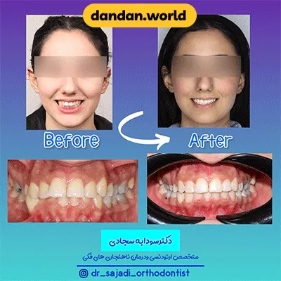 نمونه کار دیگری از ارتودنسی دندان دکتر سوادبه سجادی