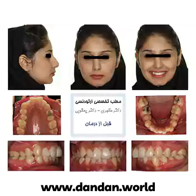 نمونه کار قبل درمان ارتودنسی دکتر مهدی یعقوبی اشرفی
