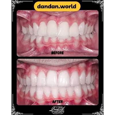 یک نمونه کار دیگر از ارتودنسی دندان دکتر مهدیه خسروی