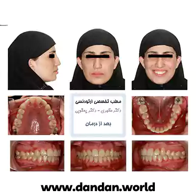 یک نمونه کار دیگر از بعد درمان ارتودنسی دکتر مهدی یعقوبی اشرفی