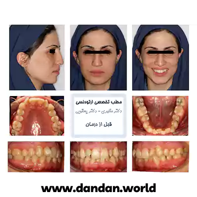 یک نمونه کار دیگر از قبل درمان ارتودنسی دکتر مهدی یعقوبی اشرفی