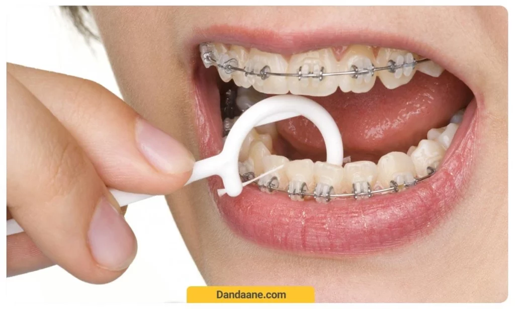 بهداشت ارتودنسی 