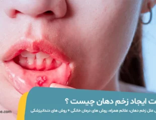 زخم دهان چیست