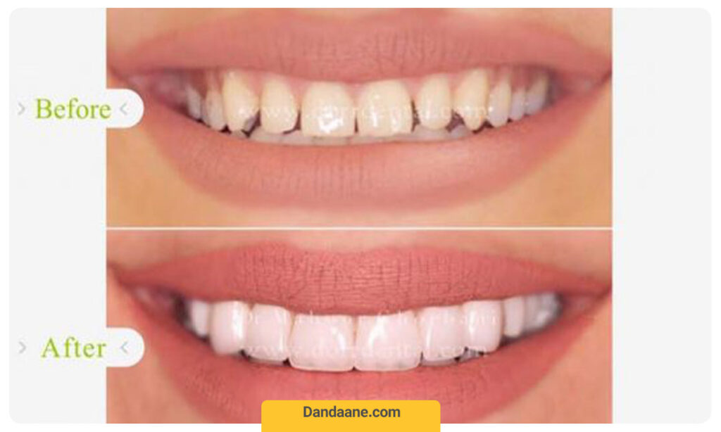 تصویری از نمونه کار قبل و بعد درمان لمینت دندان