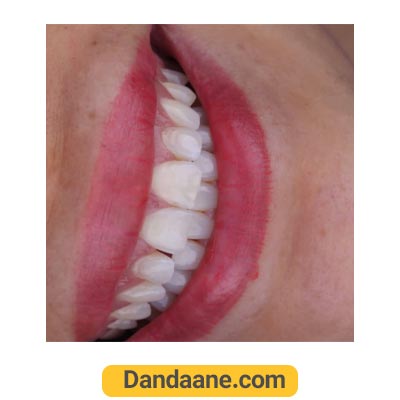 نمونه کار بعد لمینت دندان دکتر ماهور قربانی