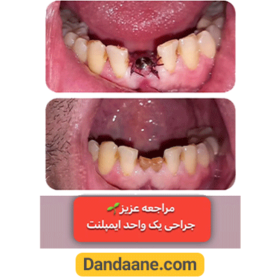 نمونه کار جراحی یک واحد ایمپلنت دندان توسط دکتر شیری لواف